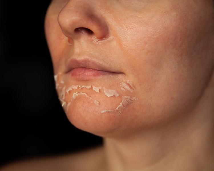 quanto tempo dura o efeito do peeling